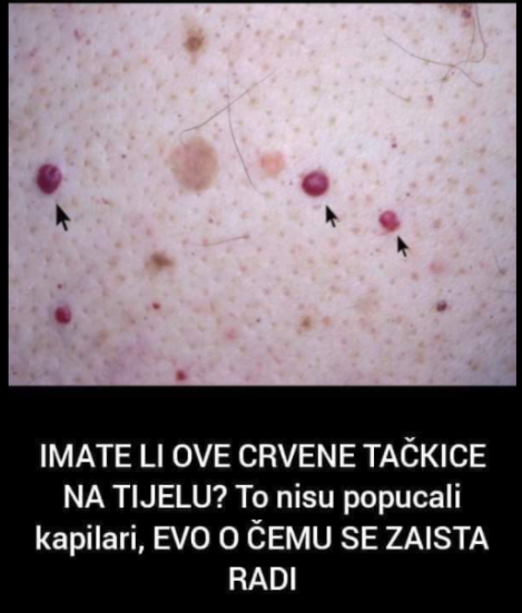 IMATE LI OVE CRVENE TAČKICE NA TIJELU? To nisu popucali kapilari, EVO O ČEMU SE ZAISTA RADI