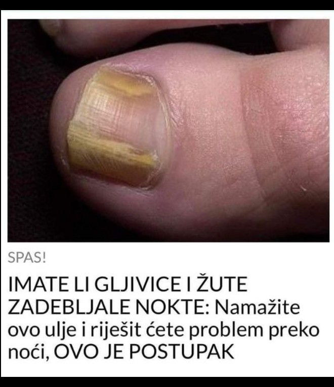 IMATE LI PROBLEME S NOKTIMA? Prirodne metode koje mogu pomoći kod gljivica