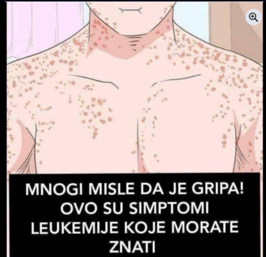 MNOGI MISLE DA JE GRIPA: Ovo su simptomi LEUKEMIJE, primijetite ih prije nego što BUDE KASNO!