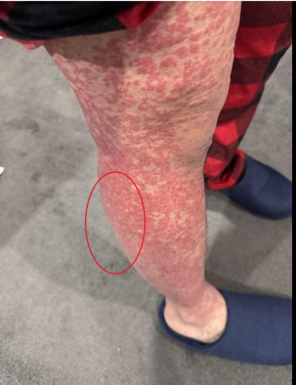 Zdravlje i prevencija: Šta je HPV i zašto je važno da i muškarci budu informisani?
