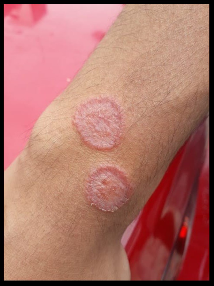 Šta je dermatofitoza (tinea corporis)?