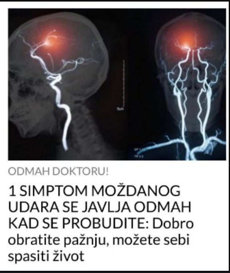 Moždani udar: Kako ga prepoznati na vreme i zašto je svaka minuta važna