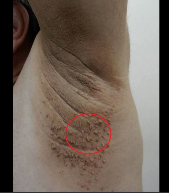Tamne mrlje na koži: Kada obratiti pažnju?