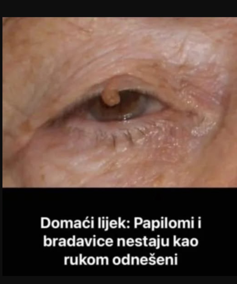 PAPILOMI I BRADAVICE NESTAJU KAO RUKOM ODNEŠENI: Samo koristite OVO, riješite ih se POTPUNO PRIRODNO