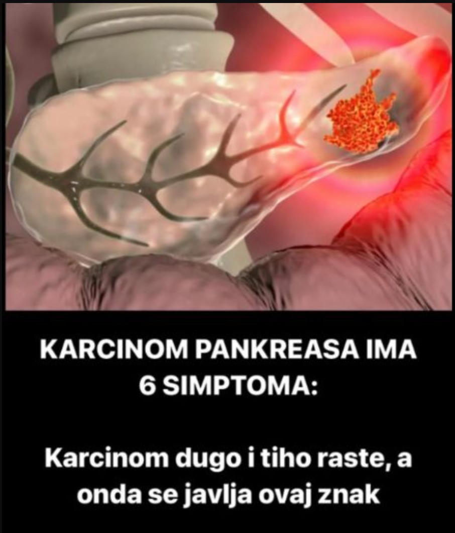 KARCINOM PANKREASA IMA 6 SIMPTOMA: Karcinom dugo i tiho raste, a onda se javlja ovaj znak