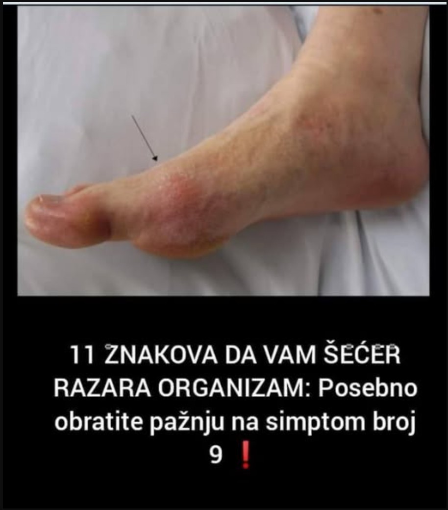 11 ZNAKOVA DA VAM ŠEĆER RAZARA ORGANIZAM: Ne ignorišite ih, posebno simptom broj 9!