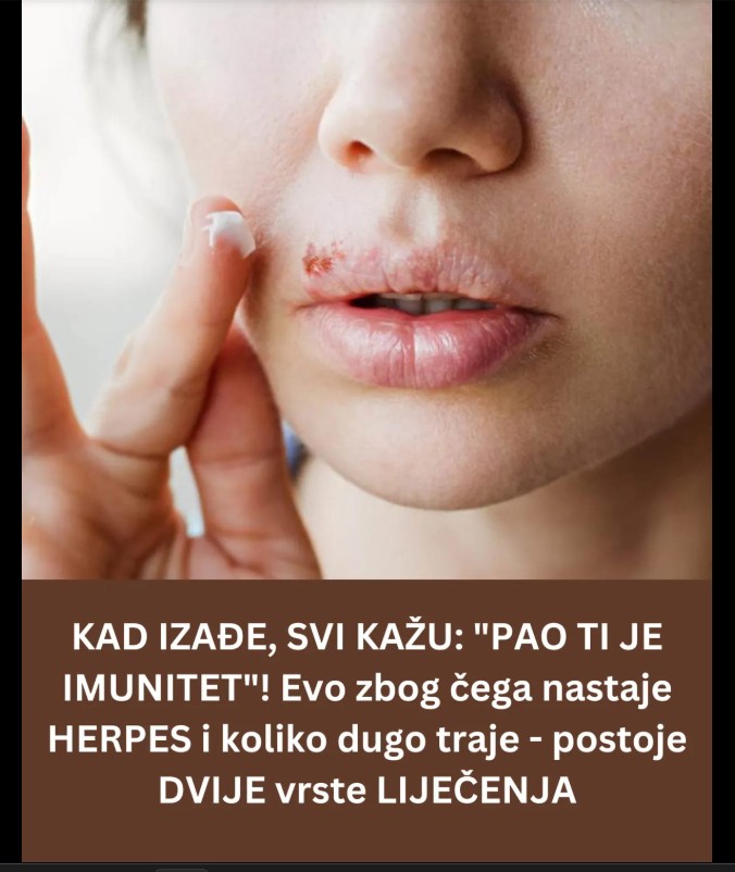 Herpes na usnama: Uzroci, simptomi i savjeti za ublažavanje tegoba