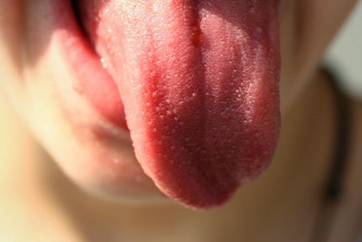 Gljivične infekcije jezika (oralna kandidijaza): simptomi, uzroci i lečenje