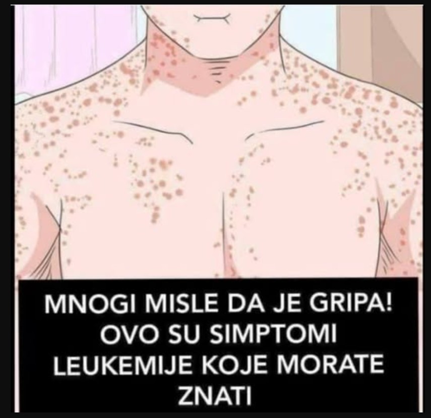 MNOGI MISLE DA JE GRIPA: Ovo su simptomi LEUKEMIJE, primijetite ih prije nego što BUDE KASNO!
