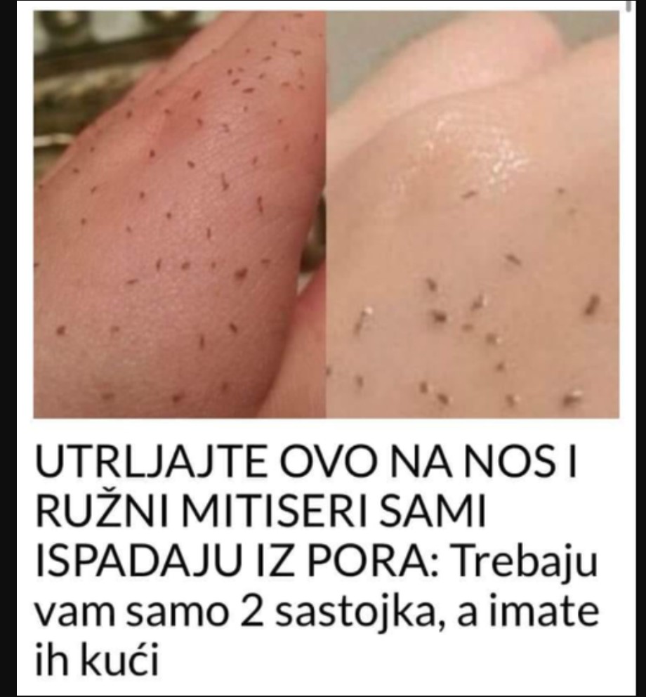 UTRLJAJTE OVO NA NOS I RUŽNI MITISERI SAMI ISPADAJU IZ PORA: Trebaju vam samo 2 sastojka, a imate ih kući