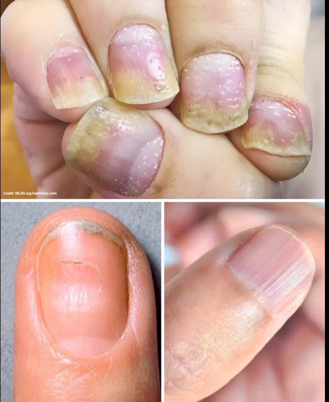 Šta vaši nokti otkrivaju o zdravlju: Skriveni znakovi koje ne smete ignorisati