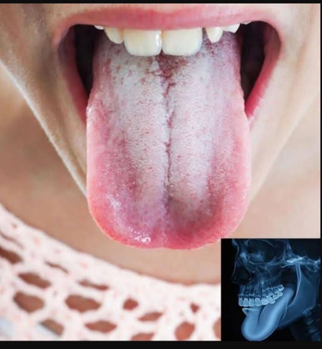 Bela obloga na jeziku – uzroci i kada posetiti lekara