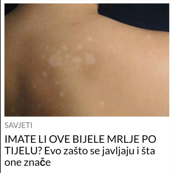 IMATE LI OVE BIJELE MRLJE PO TIJELU? Evo zašto se javljaju i šta one znače