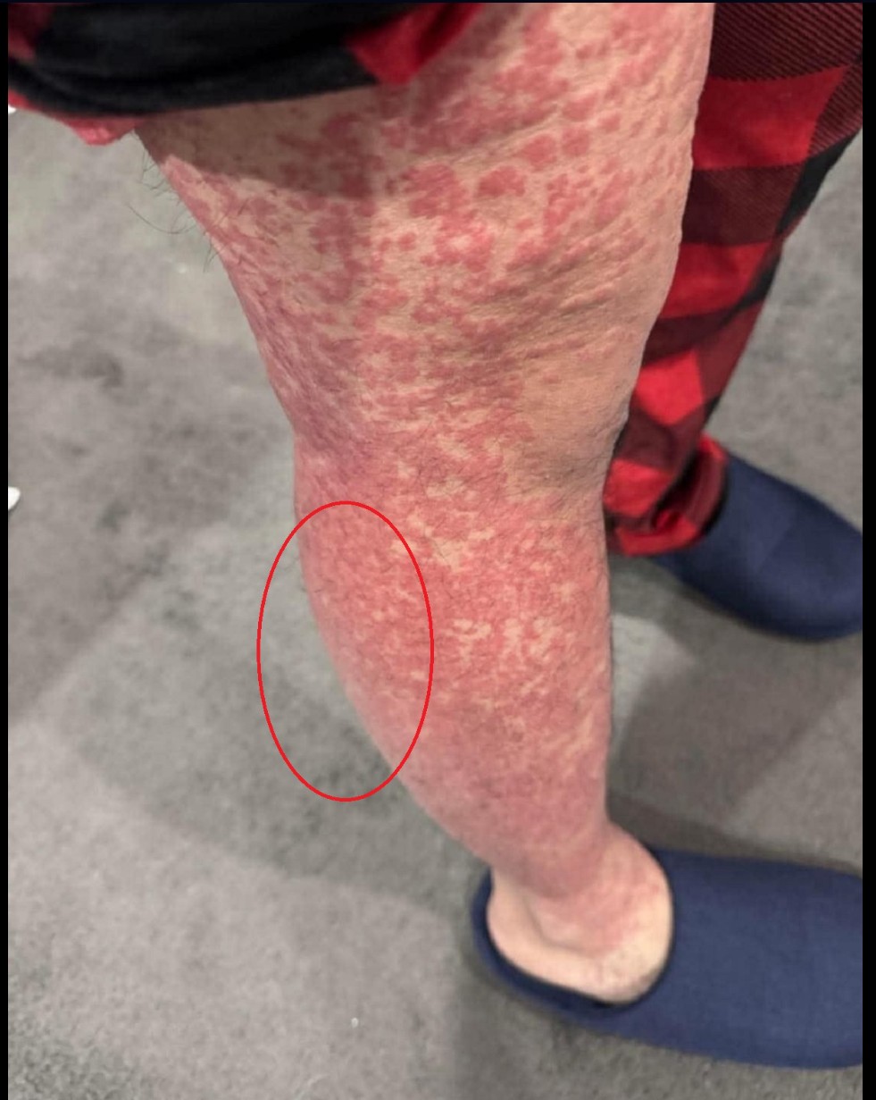 Zdravlje i prevencija: Šta je HPV i zašto je važno da i muškarci budu informisani?