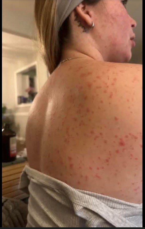 Zdravlje i prevencija: Šta je HPV i zašto je važno da i muškarci budu informisani?