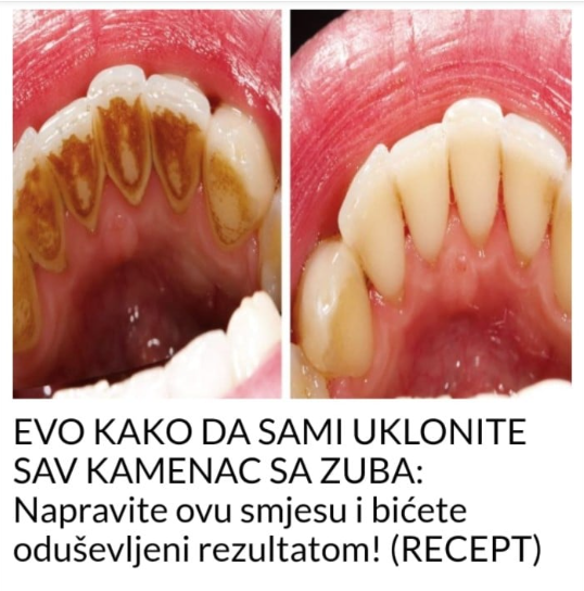 EVO KAKO DA SAMI UKLONITE SAV KAMENAC SA ZUBA: Napravite ovu smjesu i bićete oduševljeni rezultatom! (RECEPT)
