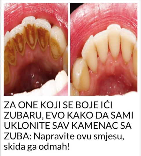 ZA ONE KOJI SE BOJE IĆI ZUBARU, EVO KAKO DA SAMI UKLONITE SAV KAMENAC SA ZUBA: Napravite ovu smjesu, skida ga odmah!