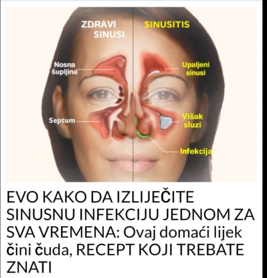 EVO KAKO DA IZLIJEČITE SINUSNU INFEKCIJU JEDNOM ZA SVA VREMENA: Ovaj domaći lijek čini čuda, RECEPT KOJI TREBATE ZNATI