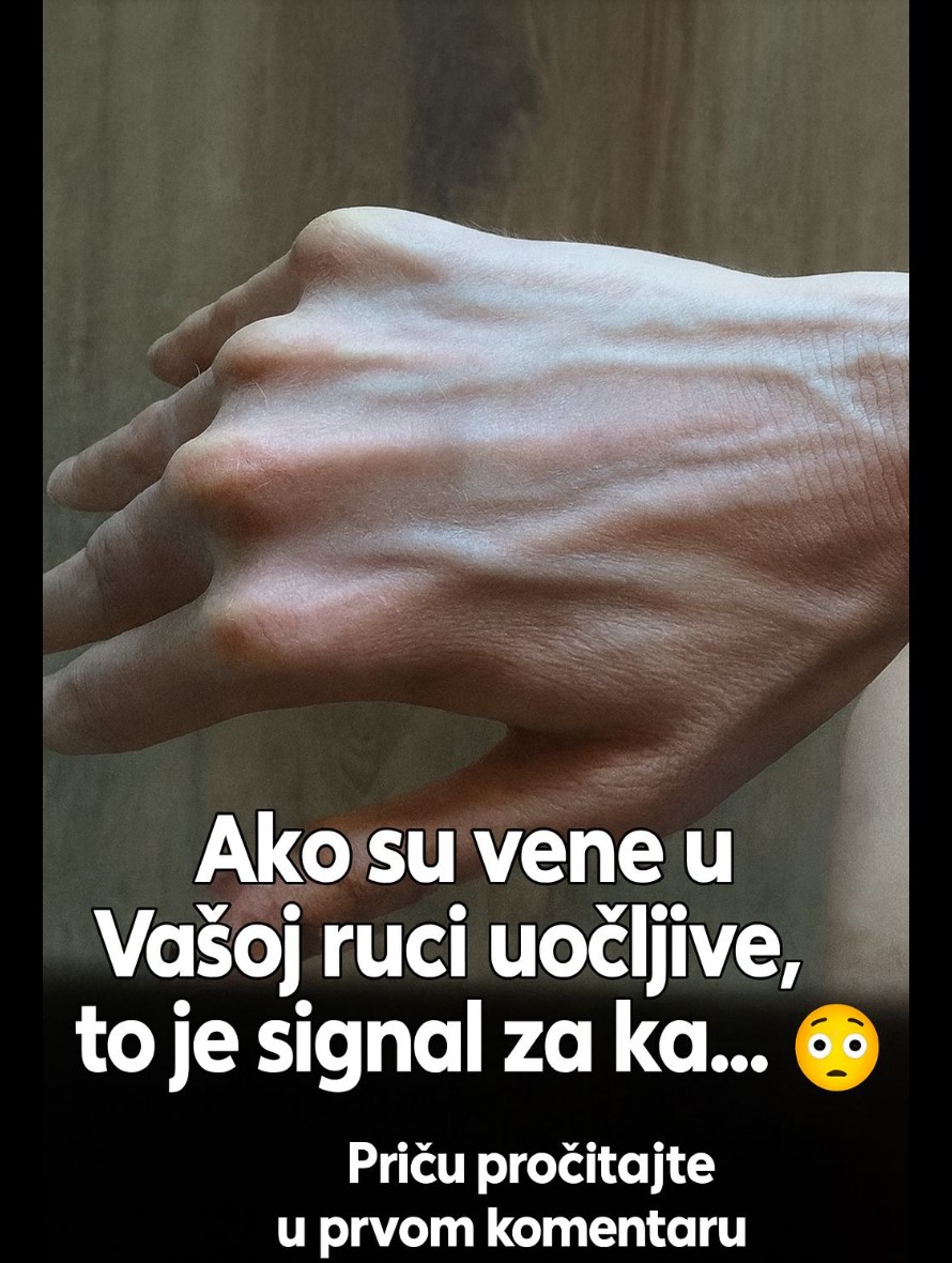 Zašto vene iznenada ispupčuju i kako ih prepoznati i sprečiti