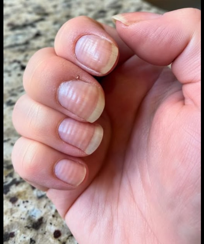 Brazde na noktima: šta znače i kada treba brinuti