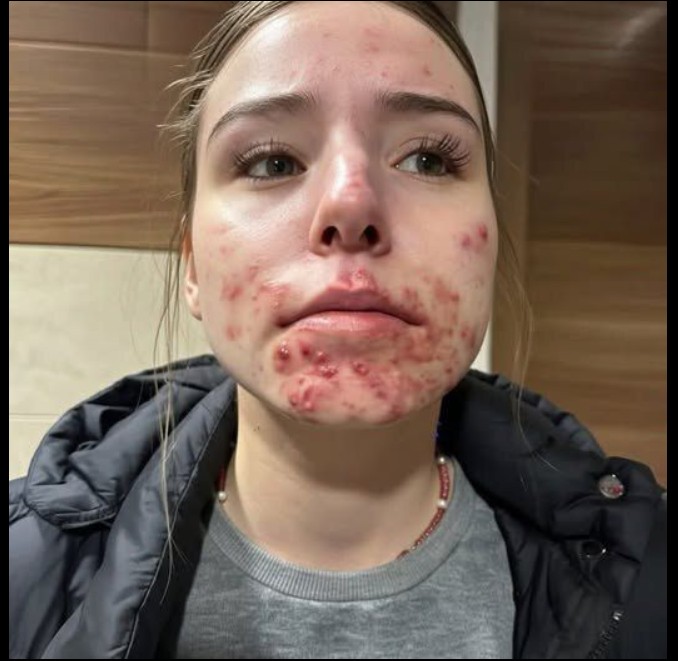 Zašto nastaju akne na bradi i kako ih konačno smiriti: Vodič za odrasle