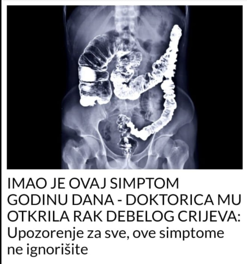 IMAO JE OVAJ SIMPTOM GODINU DANA – DOKTORICA MU OTKRILA RAK DEBELOG CRIJEVA: Upozorenje za sve, ove simptome ne ignorišite