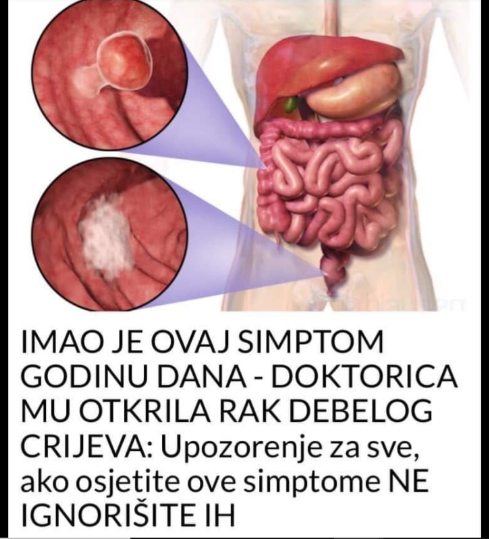 IMAO JE OVAJ SIMPTOM GODINU DANA – DOKTORICA MU OTKRILA RAK DEBELOG CRIJEVA: Upozorenje za sve, ako osjetite ove simptome NE IGNORIŠITE IH