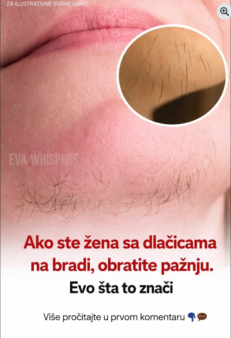 Dlačica na bradi kod žene: što znači, zašto se pojavljuje i kada je važno obratiti pažnju
