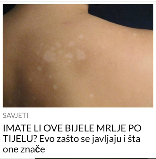 IMATE LI OVE BIJELE MRLJE PO TIJELU? Evo zašto se javljaju i šta one znače