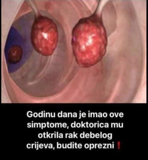 IMAO JE OVAJ SIMPTOM GODINU DANA – DOKTORICA MU OTKRILA RAK DEBELOG CRIJEVA: Upozorenje za sve, ako osjetite ove simptome NE IGNORIŠITE IH