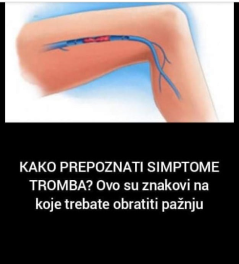 KAKO PREPOZNATI SIMPTOME TROMBA? Ovo su znakovi na koje trebate obratiti pažnju: Kada se krvni ugrušak nađe u blizini srca javljaju se sljedeći simptomi