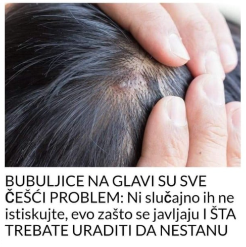 BUBULJICE NA GLAVI SU SVE ČEŠĆI PROBLEM: Ni slučajno ih ne istiskujte, evo zašto se javljaju I ŠTA TREBATE URADITI DA NESTANU