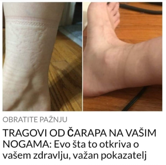 TRAGOVI OD ČARAPA NA VAŠIM NOGAMA: Evo šta to otkriva o vašem zdravlju, važan pokazatelj