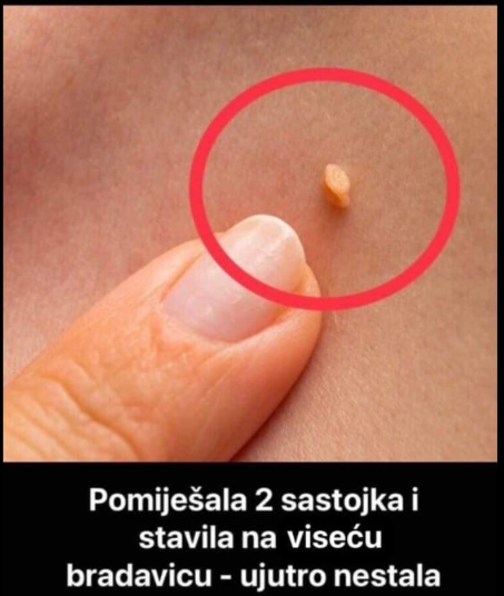 SA 2 SASTOJKA IZLIJEČILA VISEĆE BRADAVICE PREKO NOĆI: Smjesa čini čuda, ovo vrijedi probati