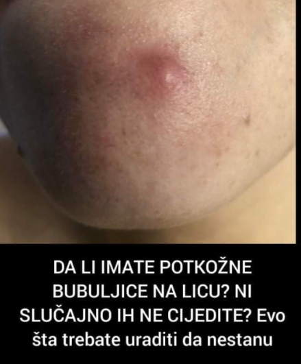 DA LI IMATE POTKOŽNE BUBULJICE NA LICU? NI SLUČAJNO IH NE CIJEDITE? Evo šta trebate uraditi da nestanu