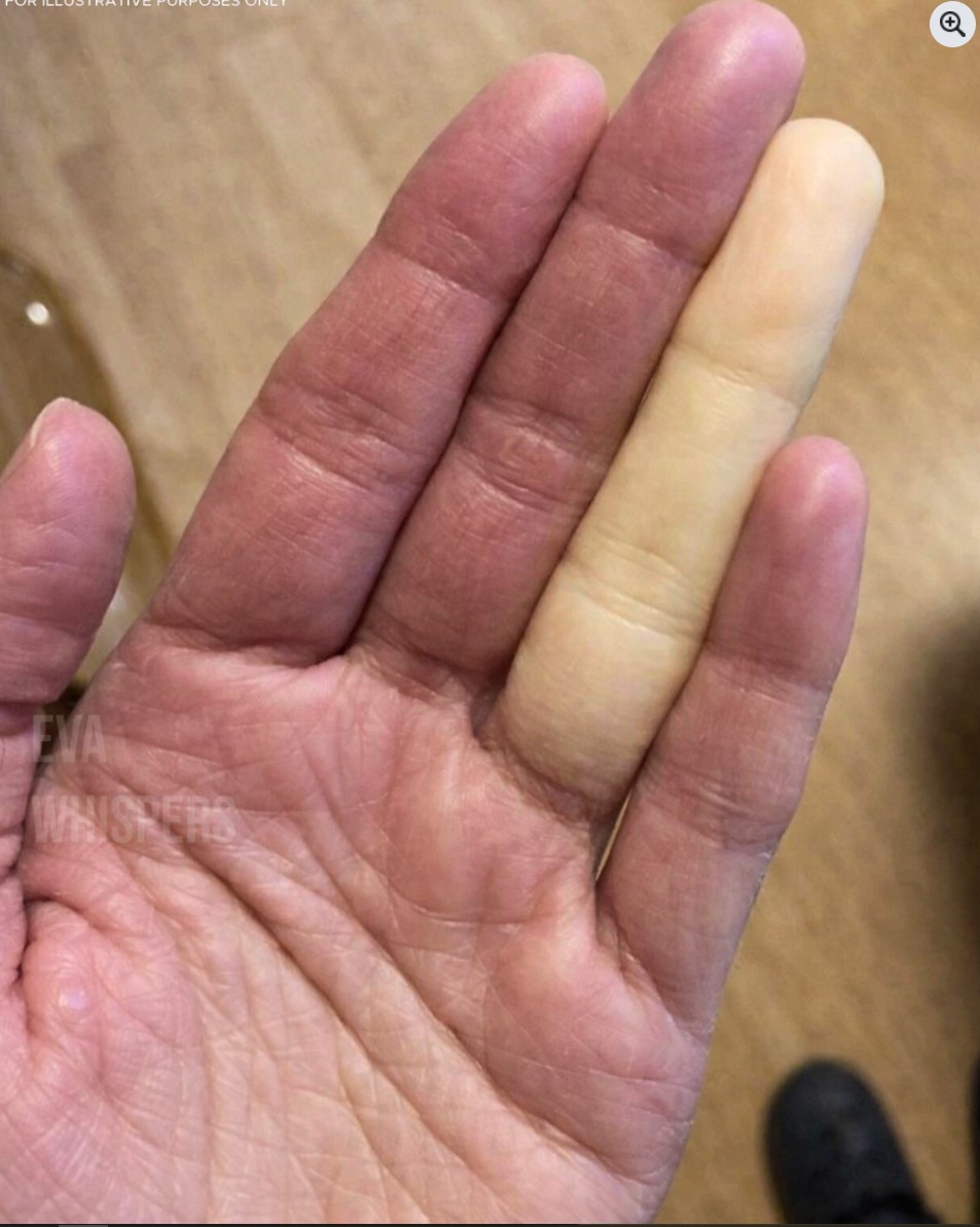 Zašto Vaši Prsti Odjednom Postaju Beli? Moguće Objašnjenje Koje Mnogi Ne Znaju