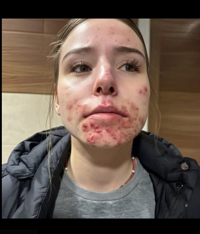 Zašto nastaju akne na bradi i kako ih konačno smiriti: Vodič za odrasle