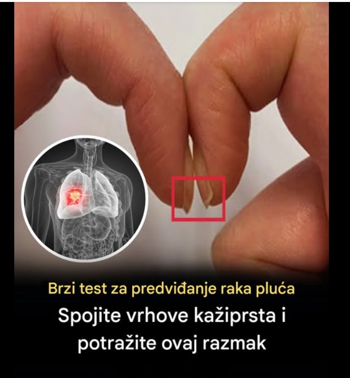 Jednostavan test sa noktima koji može ukazati da je vreme za lekarski pregled