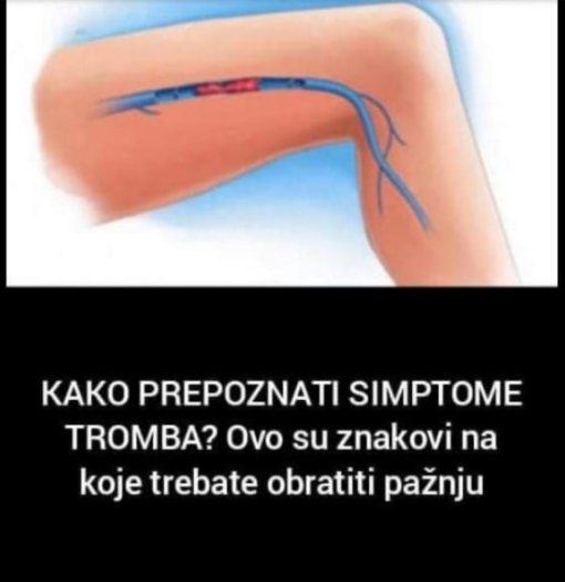 KAKO PREPOZNATI SIMPTOME TROMBA? Ovo su znakovi na koje trebate obratiti pažnju: Kada se krvni ugrušak nađe u blizini srca javljaju se sljedeći simptomi