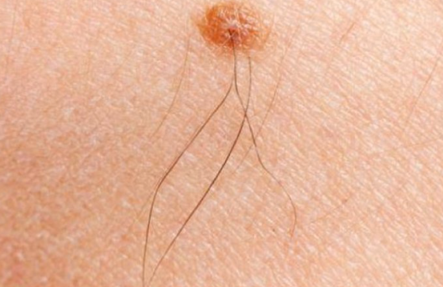 Imate li mladež iz kojeg raste dlaka? Evo šta to znači