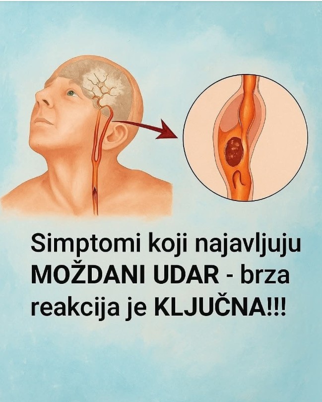 Kako prepoznati moždani udar i pravilno reagovati: Koraci koji mogu spasiti život