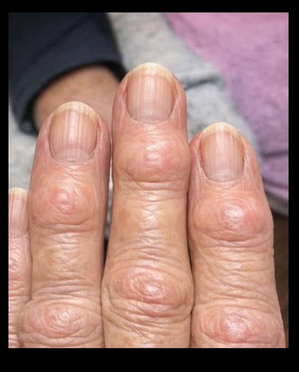 Kvržice na prstima: šta su Heberdenovi nodusi i kada treba obratiti pažnju