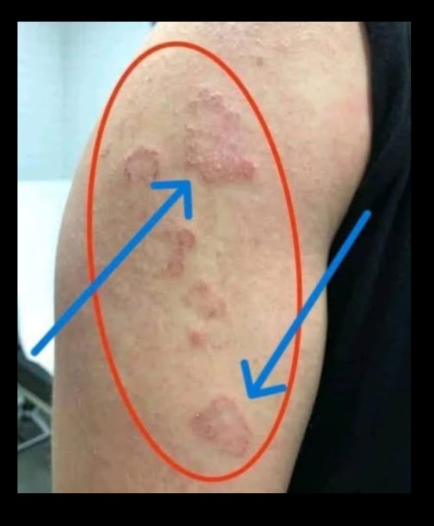 Crvene, Okrugle Promene na Koži Ruku: Zarazno ili Ne?