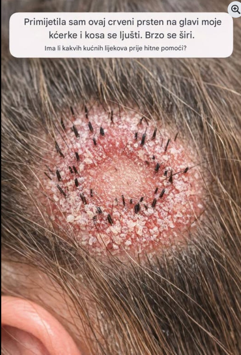 Crveni prsten na temenu kod djeteta: uzroci, simptomi i kako reagovati
