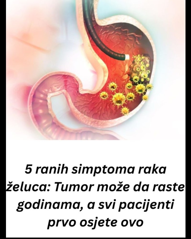 Rani simptomi raka želuca: znakovi koje ne treba zanemariti