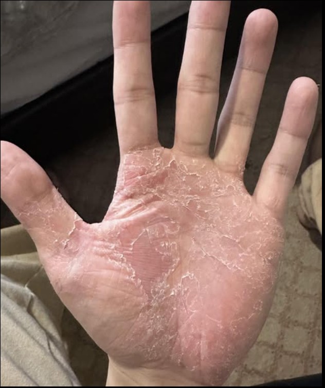 Dermatitis šaka: uzroci, simptomi i kako zaštititi kožu ruku