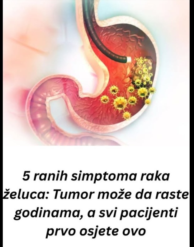 Rani simptomi raka želuca: znakovi koje ne treba zanemariti