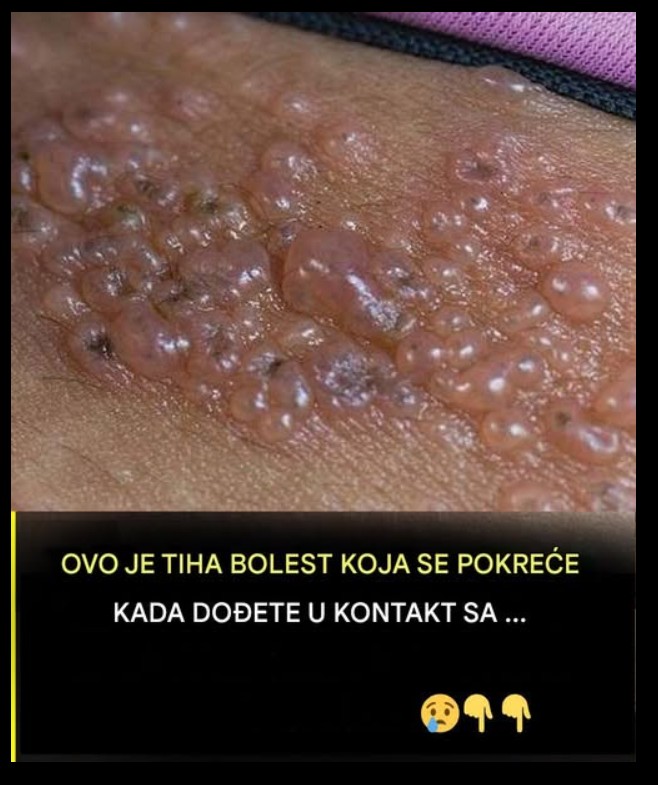 Herpes zoster (šindre): uzroci, simptomi i kada potražiti savet lekara