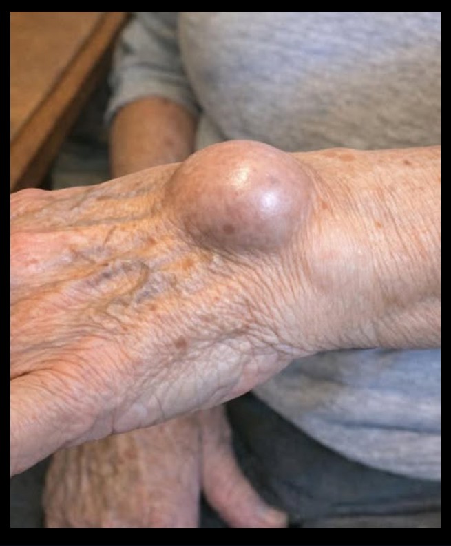 Čvorić na zglobu: uzroci, simptomi i opcije lečenja