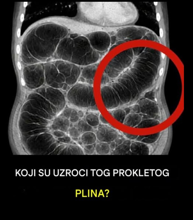 Gasovi i nadimanje: najčešći uzroci i kada obratiti pažnju
